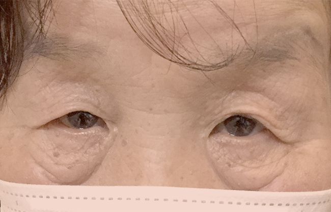 眼瞼下垂 手術前